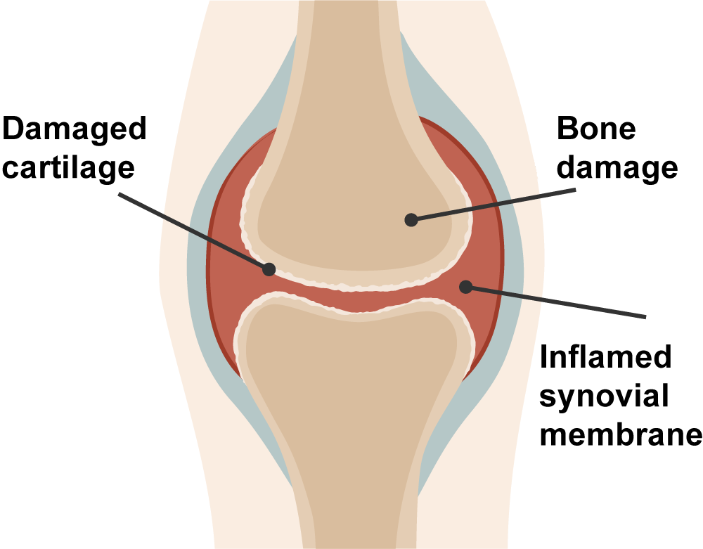Rinvoq The facts you need to know about rheumatoid arthritis (RA)